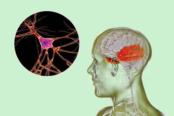 Human brain with highlighted temporal lobe and close-up view of pyramidal neurons found in temporal cortex, 3D illustration