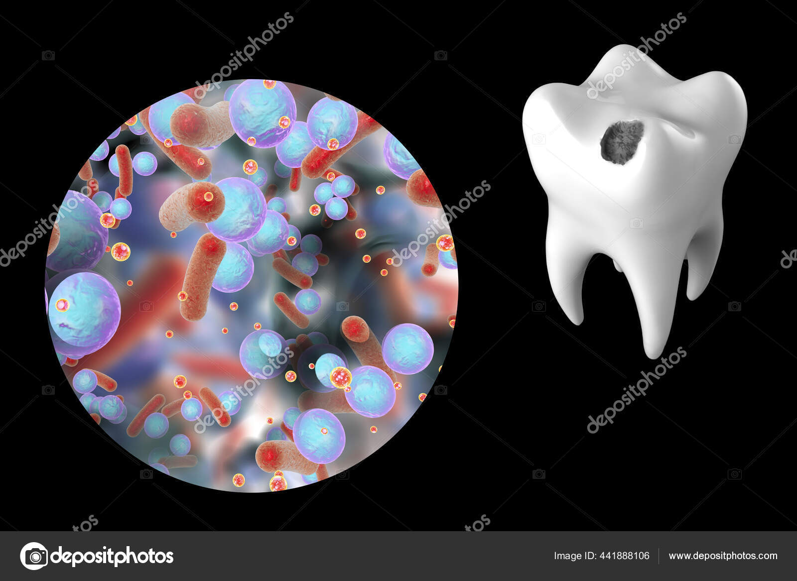 Tooth Dental Caries Close View Microbes Which Cause Caries Illustration