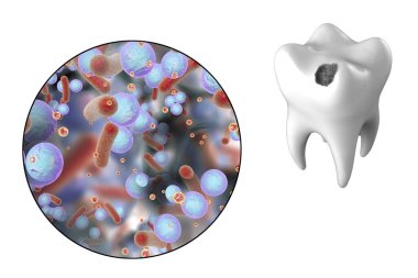Tooth with dental caries and close-up view of microbes which cause caries, 3D illustration clipart