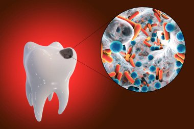 Tooth with dental caries and close-up view of microbes which cause caries, 3D illustration clipart