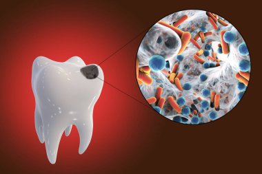 Tooth with dental caries and close-up view of microbes which cause caries, 3D illustration clipart