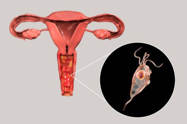 Female trichomoniasis, 3D illustration showing vaginitis and close-up view of Trichomonas vaginalis parasite clipart