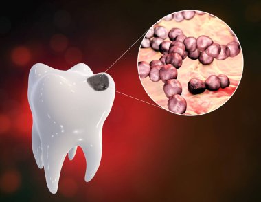 Tooth with dental caries and close-up view of microbes which cause caries Streptococcus mutans, 3D illustration clipart