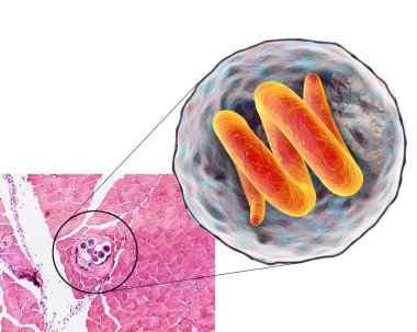 Helminth Trichinella spirali içeren kistin 3 boyutlu illüstrasyon ve mikrografı, enine kesiti, kas dokusunda nematode larva kisti, az pişmiş etin mideye indirilmesi ile bulaşır.