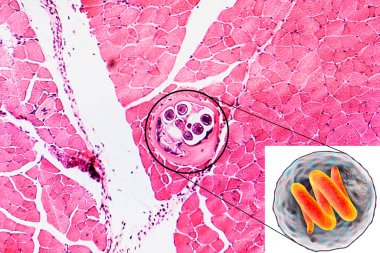 Helminth Trichinella spirali içeren kistin 3 boyutlu illüstrasyon ve mikrografı, enine kesiti, kas dokusunda nematode larva kisti, az pişmiş etin mideye indirilmesi ile bulaşır.