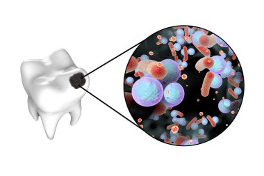 Tooth with dental caries and close-up view of microbes which cause caries, 3D illustration clipart