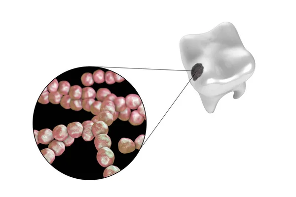 Diente Con Caries Dental Vista Cerca Los Microbios Que Causan — Foto de Stock