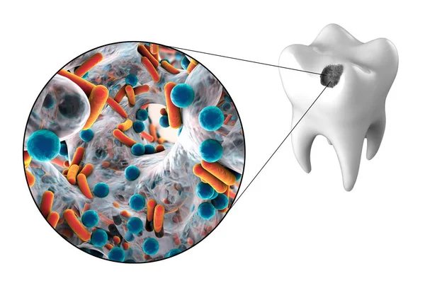 Tand Med Karies Och Närbild Mikrober Som Orsakar Karies Illustration — Stockfoto