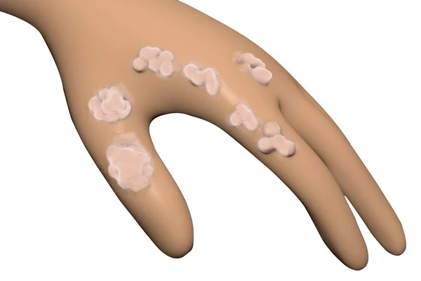 Рука Бородавками Спричиненими Папіломавірусом Людини Ілюстрація — стокове фото