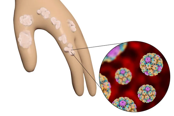 用疣子和乳头状瘤病毒的特写 导致疣子的发展 3D图解 — 图库照片