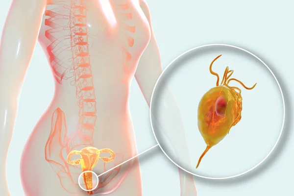 Weibliche Trichomoniasis Illustration Mit Vaginitis Und Nahaufnahme Des Parasiten Trichomonas — Stockfoto