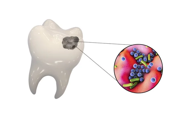 Zub Zubními Kazetami Detailním Pohledem Mikroby Které Způsobují Kazety Ilustrace — Stock fotografie