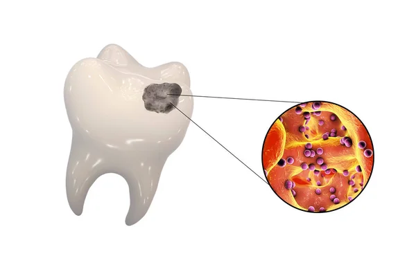 Zub Zubními Kazetami Detailním Pohledem Mikroby Které Způsobují Kazety Ilustrace — Stock fotografie