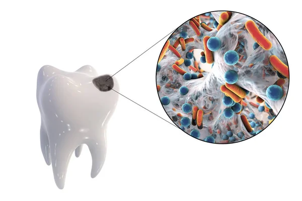 Dente Com Cárie Dentária Visão Perto Micróbios Que Causam Cárie — Fotografia de Stock
