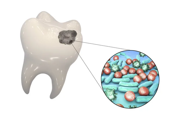 Dente Com Cárie Dentária Visão Perto Micróbios Que Causam Cárie — Fotografia de Stock