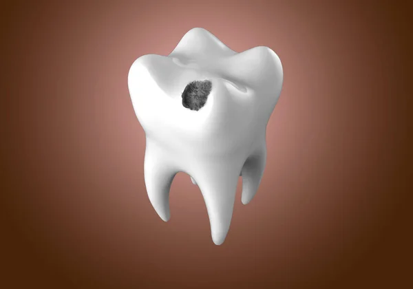 Dente Humano Com Buraco Negro Cárie Dentária Ilustração — Fotografia de Stock