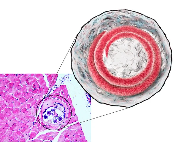 Ilustración Micrografía Sección Transversal Quiste Músculo Que Contiene Helminto Trichinella — Foto de Stock