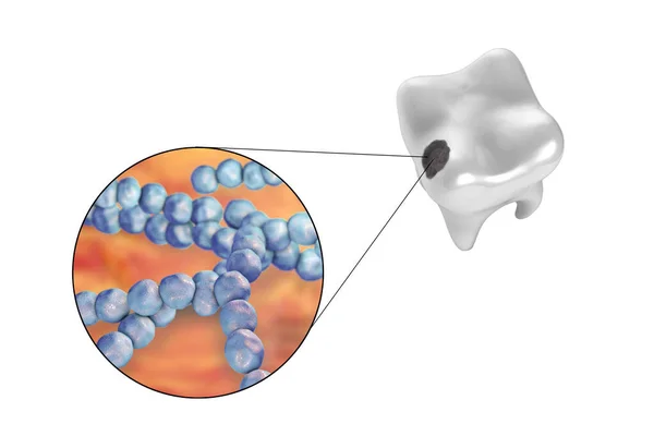 Tand Met Tandcariës Close Zicht Microben Die Cariës Veroorzaken Streptococcus — Stockfoto