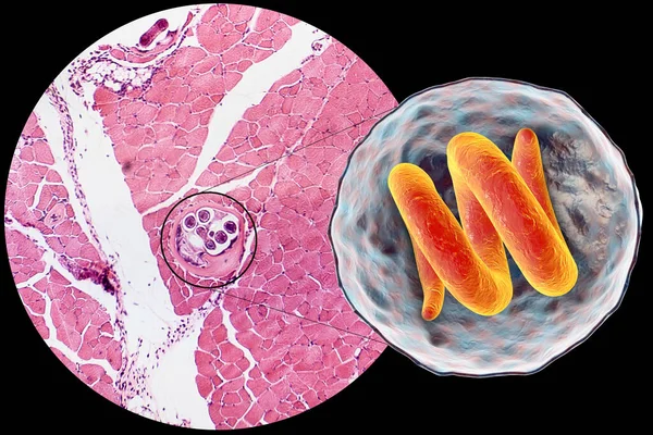 含螺旋藻蠕虫 线虫幼虫囊的肌肉囊肿的三维图像及横断面显微图像 通过低熟肉食传播 — 图库照片