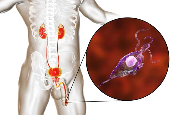 Infecção Por Tricomoníase Homem Ilustração Mostrando Anatomia Masculina Sistema Geniturinário — Fotografia de Stock
