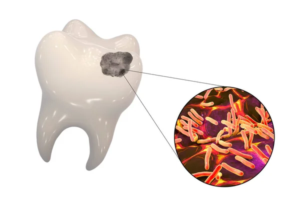 Zub Zubními Kazetami Detailním Pohledem Mikroby Které Způsobují Kazety Ilustrace — Stock fotografie