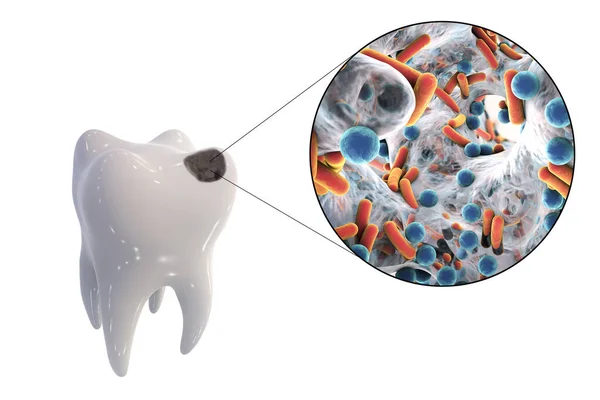 带有蛀牙的牙齿和引起蛀牙的微生物的特写 3D图解 — 图库照片