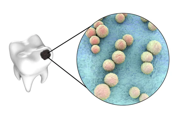 Ząb Próchnicą Widok Bliska Drobnoustrojów Powodujących Próchnicę Streptococcus Mutans Ilustracja — Zdjęcie stockowe