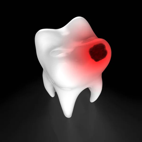 Diente Humano Con Agujero Negro Aislado Sobre Fondo Negro Caries —  Fotos de Stock