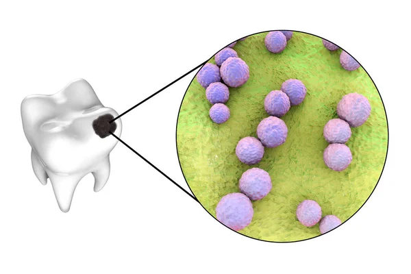 带有蛀牙的牙齿和引起蛀牙链球菌变异的微生物的特写 3D说明 — 图库照片