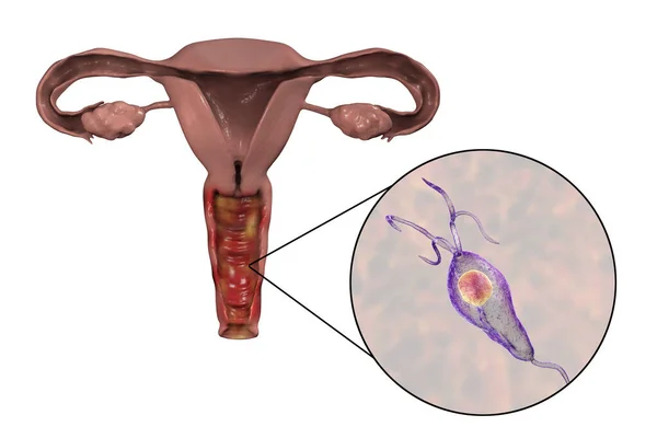 Vrouwelijke Trichomoniasis Illustratie Met Vaginitis Close Zicht Trichomonas Vaginalis Parasiet — Stockfoto