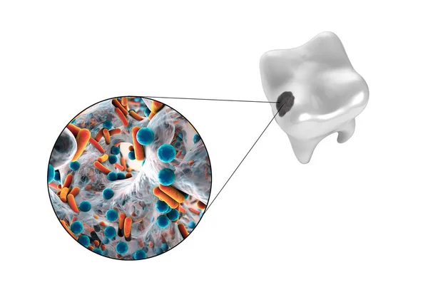 带有蛀牙的牙齿和引起蛀牙的微生物的特写 3D图解 — 图库照片