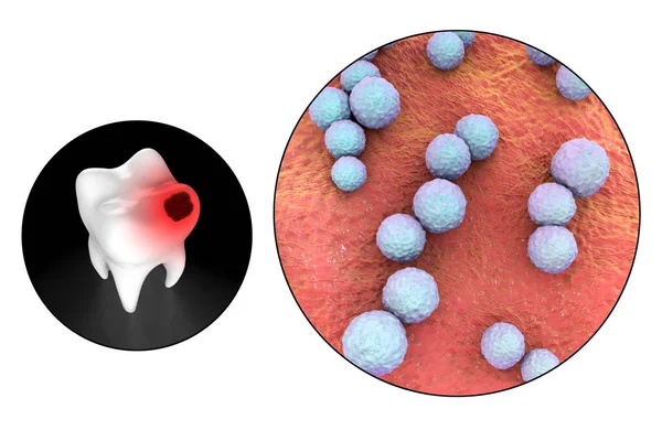 Ząb Próchnicą Widok Bliska Drobnoustrojów Powodujących Próchnicę Streptococcus Mutans Ilustracja — Zdjęcie stockowe
