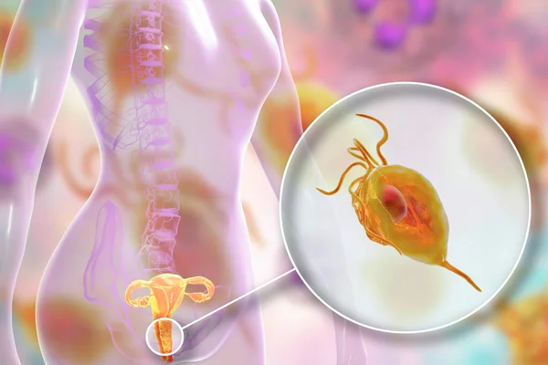 Weibliche Trichomoniasis Illustration Mit Vaginitis Und Nahaufnahme Des Parasiten Trichomonas — Stockfoto