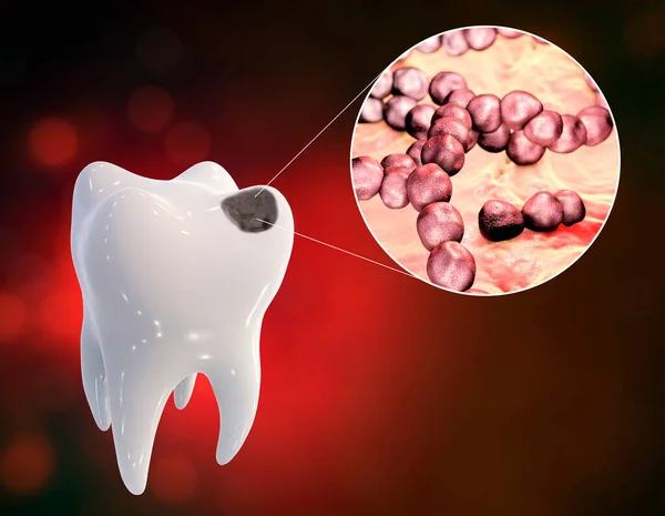 Zub Zubními Kazetami Detailním Pohledem Mikroby Které Způsobují Caries Streptococcus — Stock fotografie