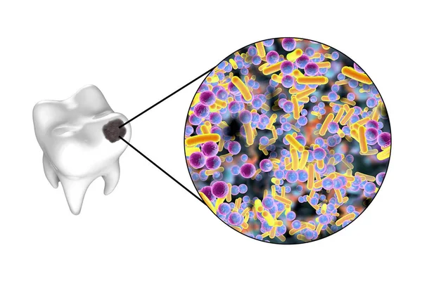 带有蛀牙的牙齿和引起蛀牙的微生物的特写 3D图解 — 图库照片