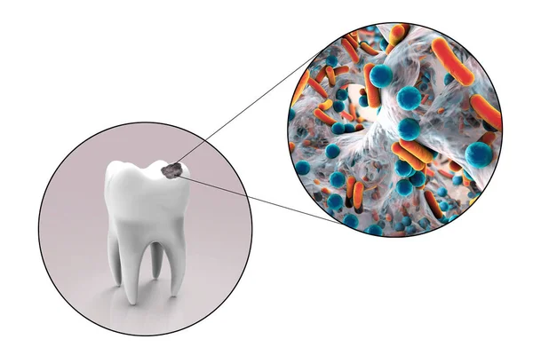 Dente Com Cárie Dentária Visão Perto Micróbios Que Causam Cárie — Fotografia de Stock