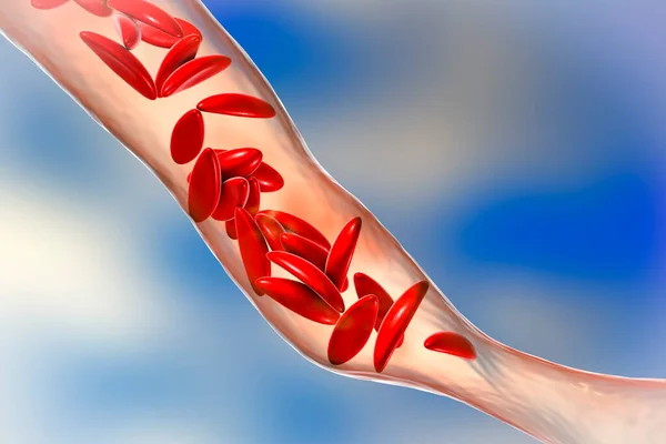 Sickle Cell Anemia Illustration Clumps Sickle Cell Block Blood Vessel — Stock Photo, Image