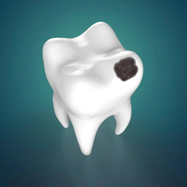 Человеческий Зуб Черной Дырой Кариес Иллюстрация — стоковое фото