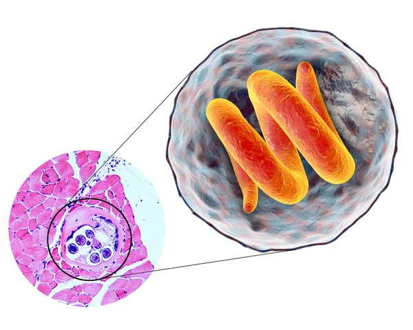 Illustration Och Mikrografi Tvärsnitt Cysta Muskler Som Innehåller Helminth Trichinella — Stockfoto