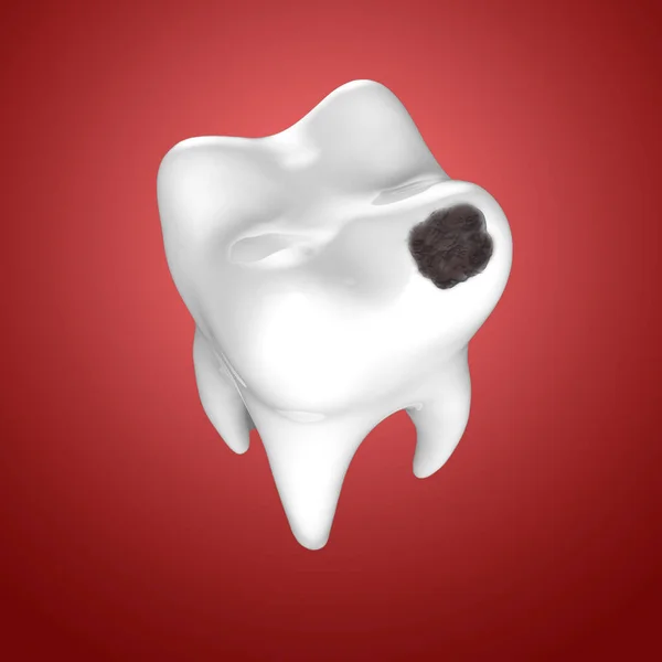 Dente Umano Con Buco Nero Carie Dentali Illustrazione — Foto Stock