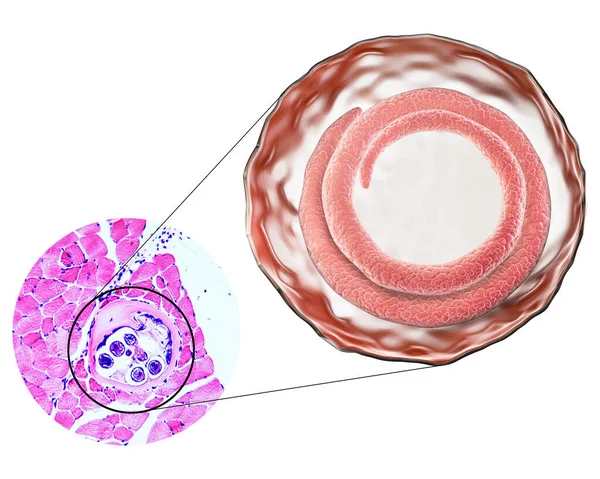 Ilustración Micrografía Sección Transversal Quiste Músculo Que Contiene Helminto Trichinella — Foto de Stock