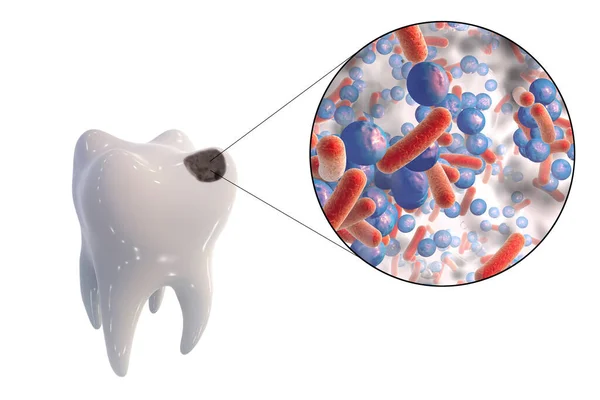 Diente Con Caries Dental Vista Cerca Microbios Que Causan Caries — Foto de Stock