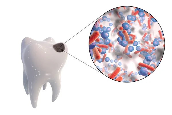 Zub Zubními Kazetami Detailním Pohledem Mikroby Které Způsobují Kazety Ilustrace — Stock fotografie
