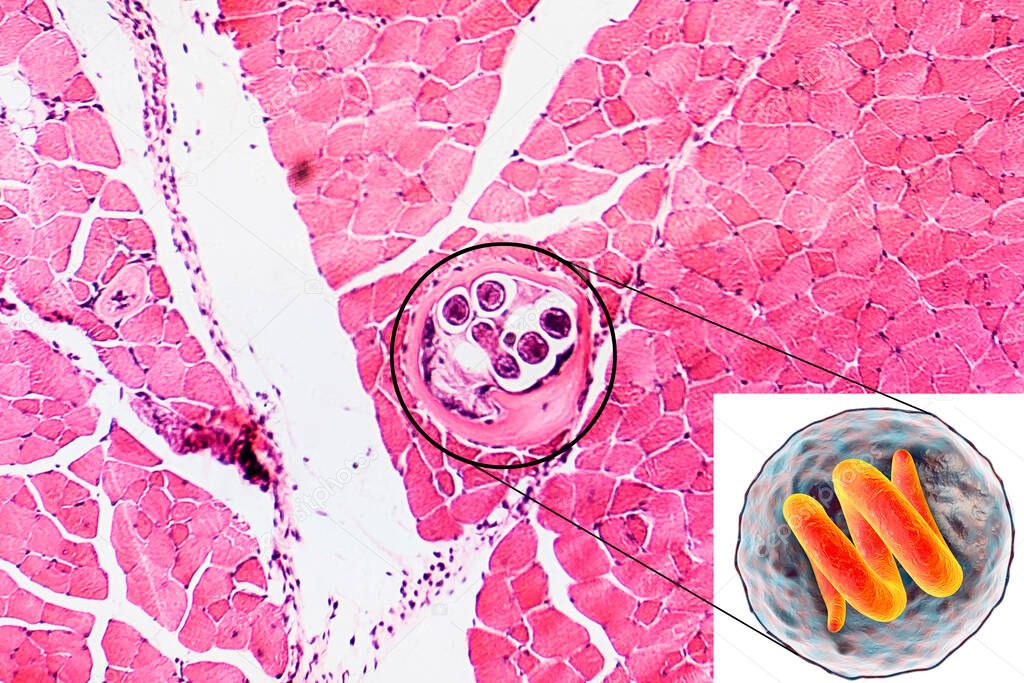 3D illustration and micrograph, transverse section, of cyst in muscle containing helminth Trichinella spiralis, nematode larval cyst in muscle tissue, transmitted by ingestion of undercooked meat