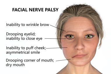 Facial nerve paralysis, Bell's palsy, 3D illustration showing female with one-sided facial nerve paralysis clipart