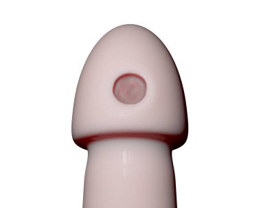 Syphilitic ulcer ulcus durum on the surface of a penis isolated on white background, 3D illustration