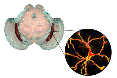 Black substance, basal banglia of the midbrain, in Parkinson's disease, 3D illustration showing decrease of its volume and degeneration of dopaminergic neurons in the pars compacta of the black substance clipart