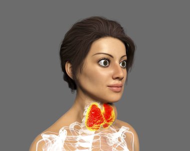 Hyperthyroidism. 3D illustration showing enlarged thyroid gland and exophthalmos (bulging eyes) in a female with Graves' disease, also known as toxic diffuse goiter clipart