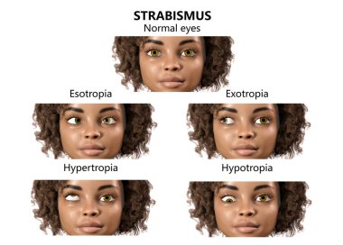 Çocuklarda strabismus, 3 boyutlu illüstrasyon farklı göz sapmaları gösteriyor