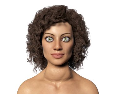 Hipertiroidizm. Graves hastalığı olan, ayrıca zehirli difüzyon guatrı olarak da bilinen, tiroid bezini ve exophthalmos 'u büyüten bir kadını gösteren 3 boyutlu bir çizim.